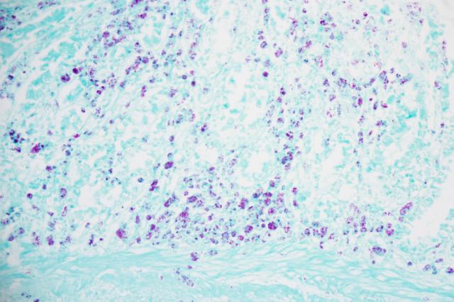Alcohol Detection Systems >> Acid Fast Bacteria Stain Kit Ziehl Neelsen - Newcomer Supply Alcohol Detection Systems >> Acid Fast Bacteria Stain Kit Ziehl Neelsen - Newcomer Supply