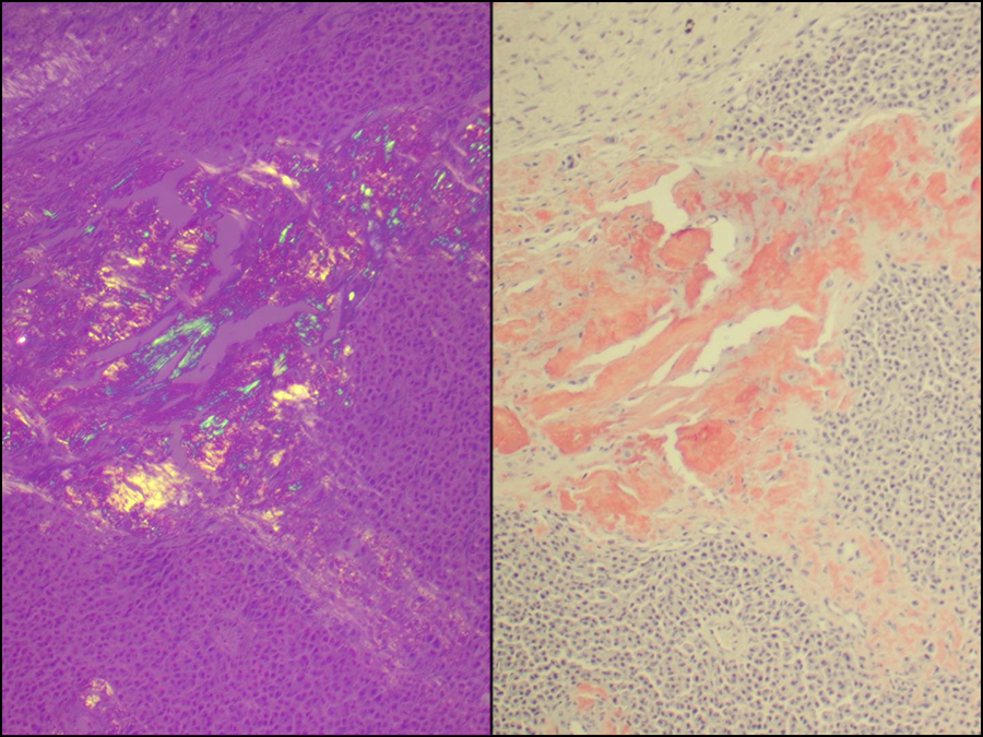 Histological Stain Kit Amyloid, Puchtler Congo Red