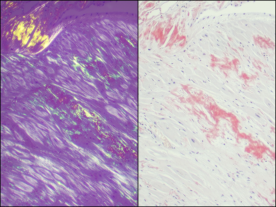 Histological Stain Kit Amyloid, Bennhold Congo Red