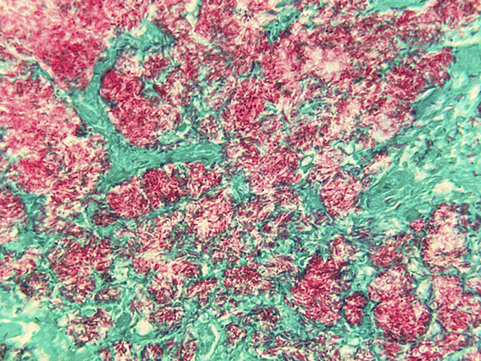 Spleen (Mycobacterium leprae) Custom Tissue Slides