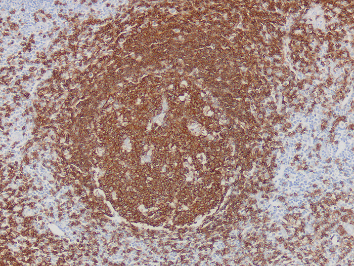 CD20, B-cell Stained Histology Slide