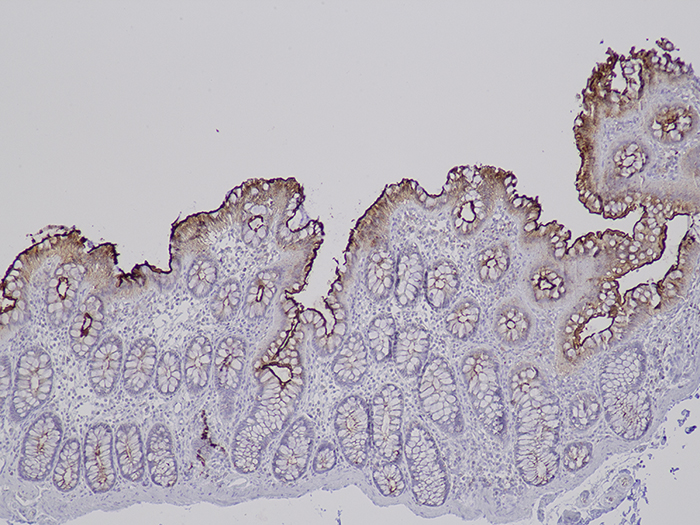 Carcinoembryonic Antigen (CEA) Stained Histology Slide