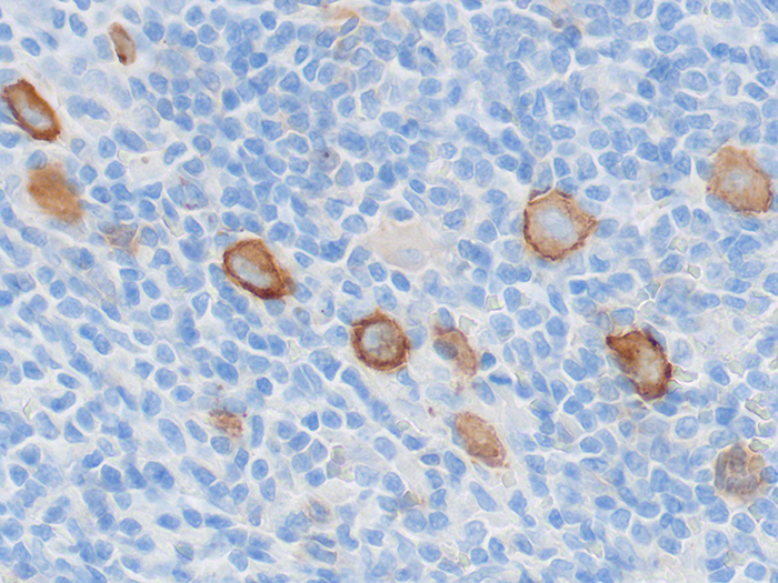 CD30 Stained Histology Slide
