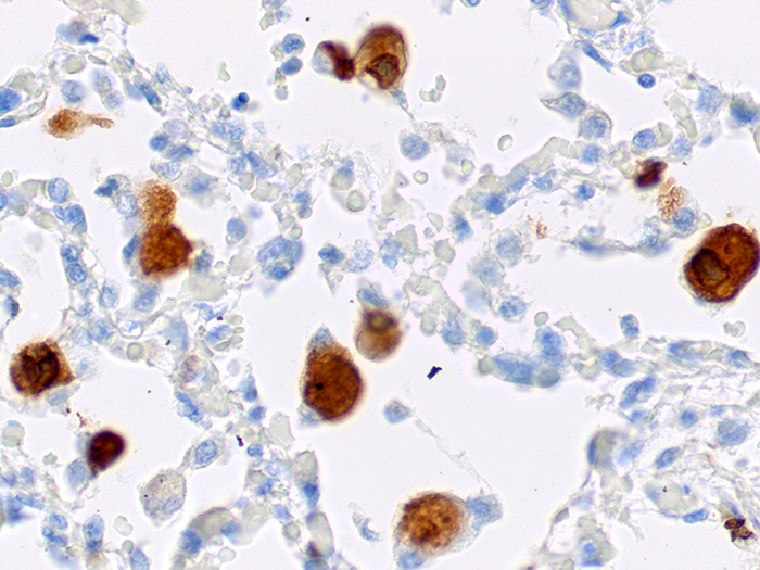 Cytomegalovirus (CMV) Stained Histology Slide