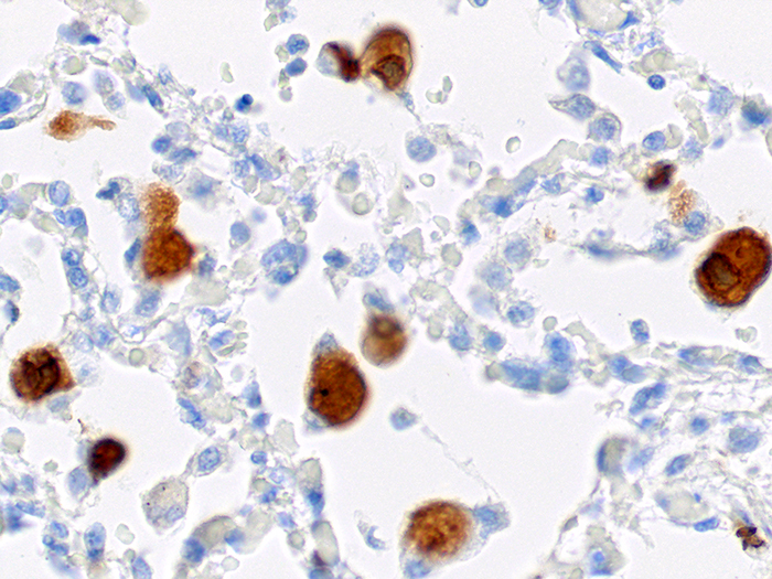 Cytomegalovirus (CMV) Stained Histology Slide