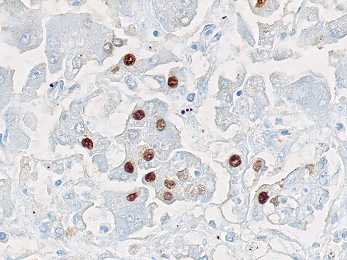 Hepatitis B Core Antigen (HBcAG) Stained Histology Slide