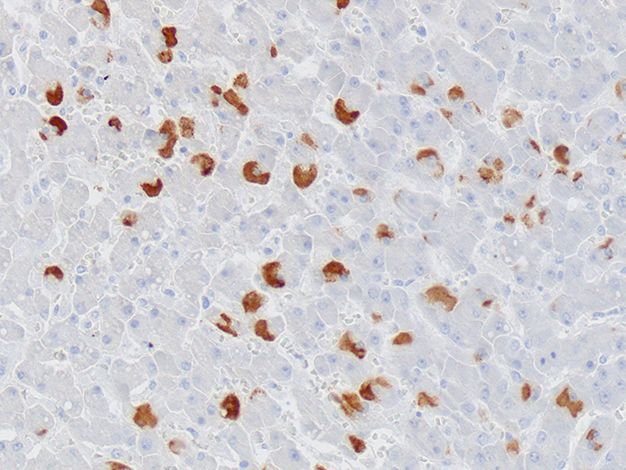 Hepatitis B Surface Antigen (HBsAG) Stained Histology Slide