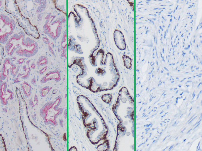 CK5/14 + p63 + P504S, Multi-Tissue Stained Histology Slide