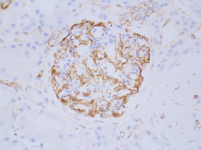 Wilms' Tumor (WT1) Stained Histology Slide