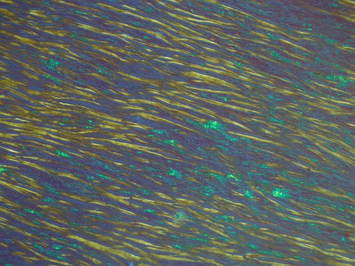 Amyloid Stained Histology Slide