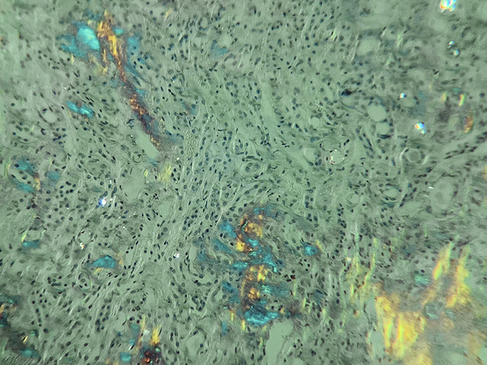 Amyloid, Animal Stained Histology Slide