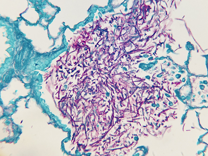 Fungus, PAS, Aspergillus sp., Artificial Stained Histology Slide