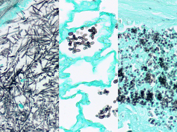 Fungus, GMS, Multi-Tissue, Artificial Stained Histology Slide