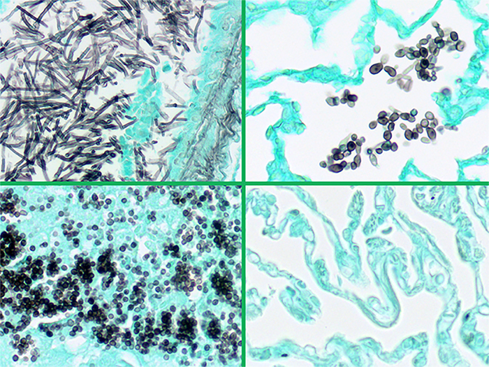 Fungus, GMS, Multi-Tissue, Artificial Stained Histology Slide