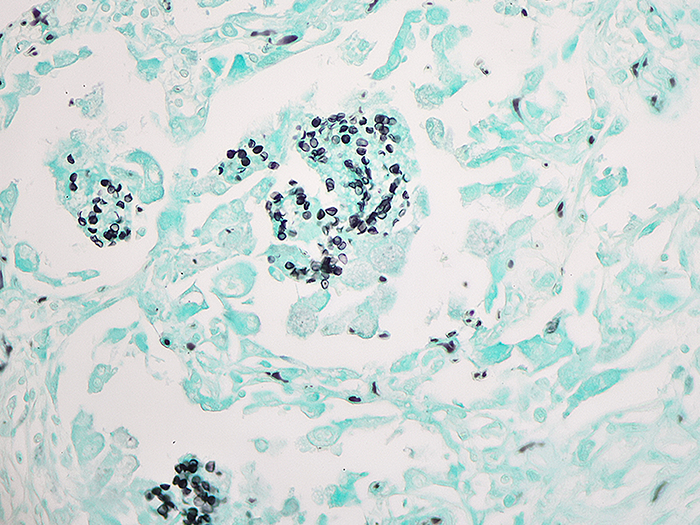 Pneumocystis Histology Slides