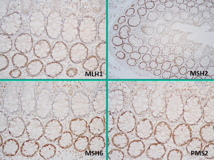 Mismatch Repair (MMR) Positive Stained Histology Slide