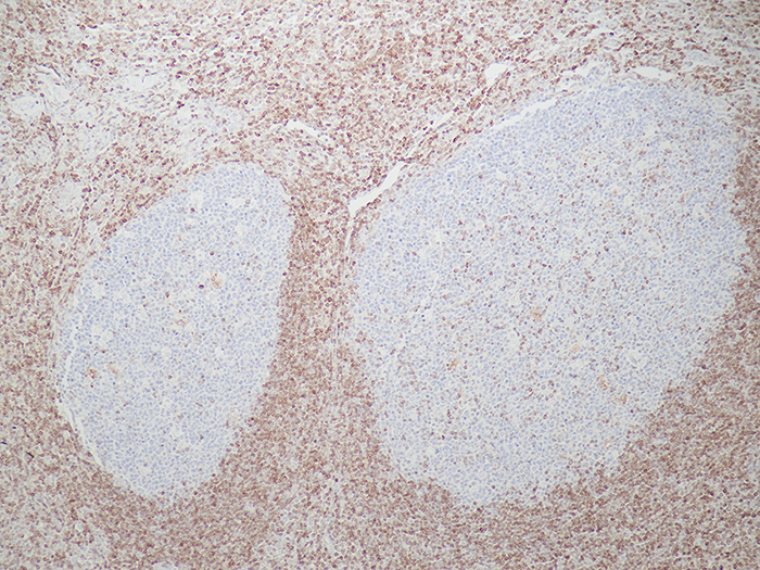 BCL2 Stained Histology Slide