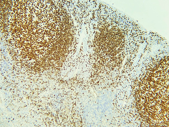 PAX5 Stained Histology Slide