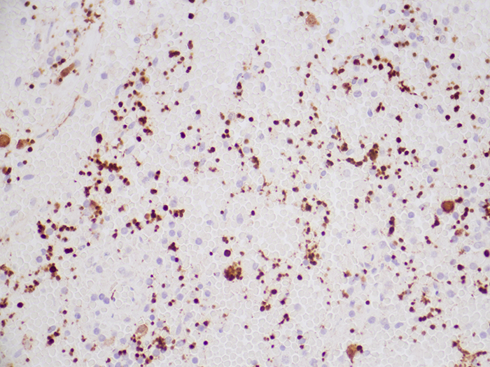 Factor XIIIa Stained Histology Slide