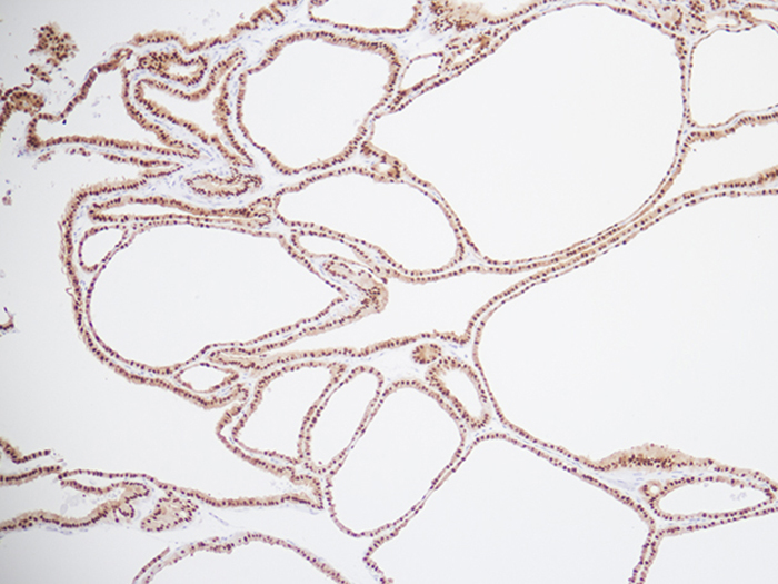 PAX8 Stained Histology Slide