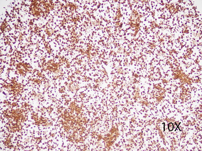 ALK-Lymphoma Cell Line Stained Histology Slide