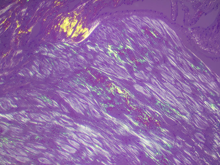 Amyloid Stained Histology Slide