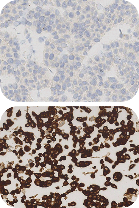 Anaplastic Lymphoma Kinase (ALK-1) Histology Slide Image