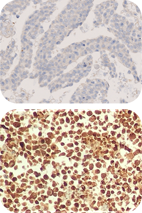 Anaplastic Lymphoma Kinase (ALK-1) Histology Slides