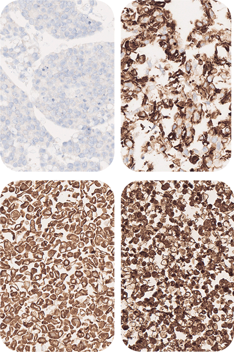 Anaplastic Lymphoma Kinase Histology Slides & Blocks - HistoCyte